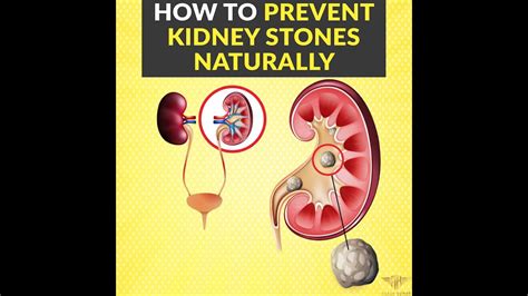 How To Prevent Kidney Stones Naturally Youtube