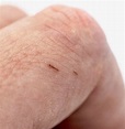 How to remove a splinter: Methods and tips