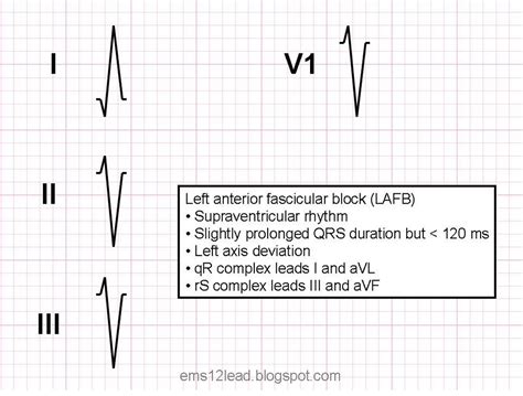 Left Anterior Fascicular Block Lafb