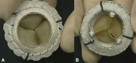 Sutureless Mitral Valve Replacement With Bioprostheses And Nitinol