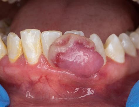 Patología Bucal U Oral Clínica Dental Odontovida