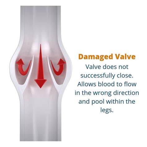 What Are Valves In Veins And How Do They Work Usa Vein Clinics