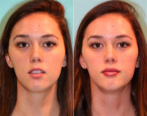 lip augmentation photos chevy chase md patient 15012