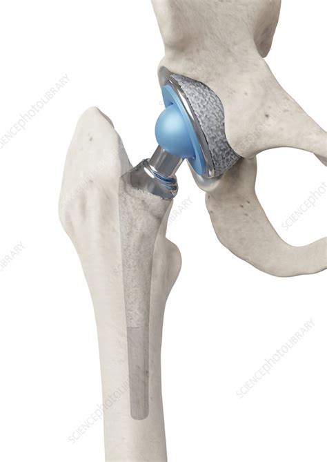 Hip Replacement Artwork Stock Image C052 3630 Science Photo Library