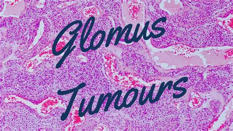 Glomus Tumours Pathology Mini Tutorial Youtube