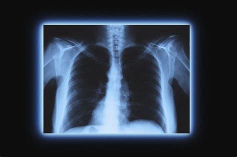 What You Need To Know About X Rays X Ray Cancer Screening Cancer