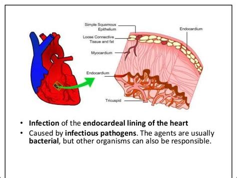 Infective Endocarditis Paediatrics
