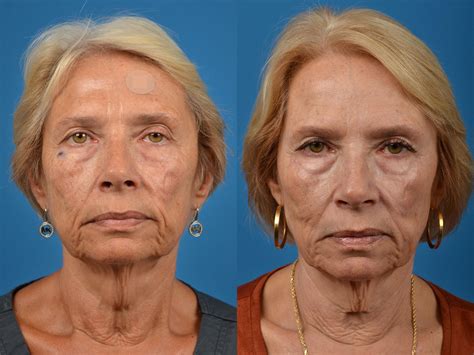 patient 122406417 mohs surgery and skin cancer before and after photos clevens face and body
