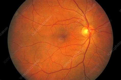 Healthy Eye Fundus Image Stock Image C0261048 Science Photo Library