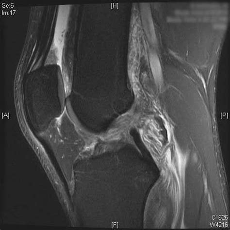 Arthroscopic Acl Reconstruction With Bone Patellar Bone Graft Using