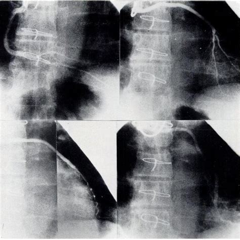 Postoperative Study Of Quadruple Bypass A Upper Left Graft To Right