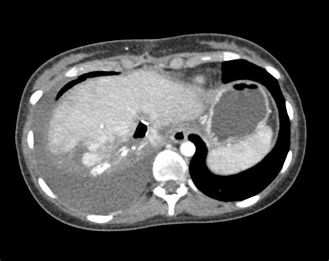Liver Laceration In The Liver Trauma Case Studies Ctisus Ct Scanning