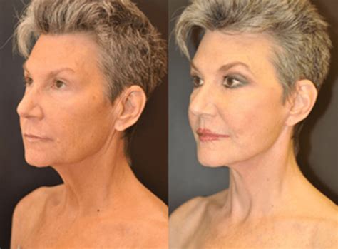 Mini Facelift Dr Dean Kane Baltimore Maryland