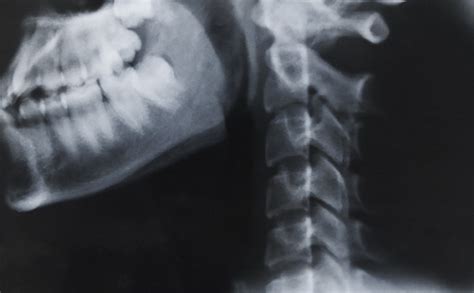 C1 And C2 Vertebrae Spinal Cord Injury