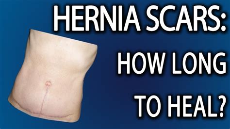 Stomach Hernia Surgery