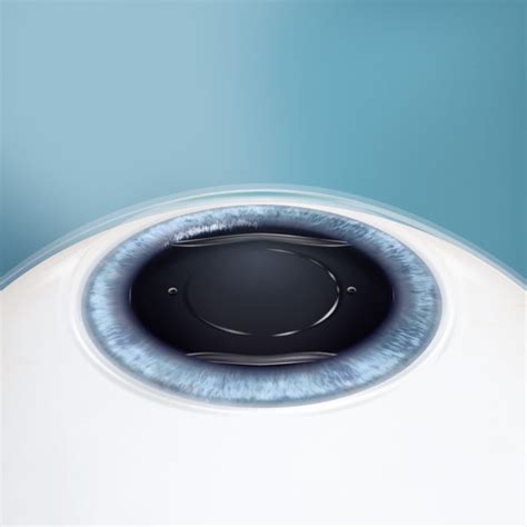 Implantable Collamer Lens Icl Technology Providence Eye Providence Eye