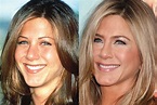 Has Jennifer Aniston Had Cosmetic Surgery?