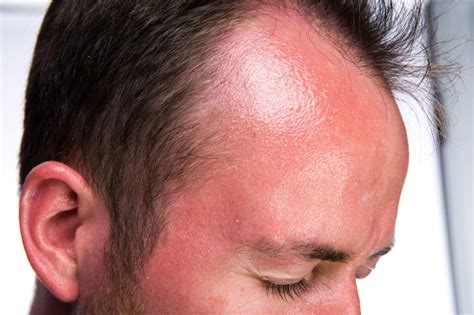 23 Natural Remedies For Your Sunburn And Some To Avoid