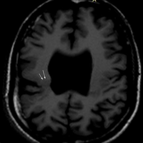 At The Level Of Lateral Ventricle T2w Magnetic Resonance Imaging