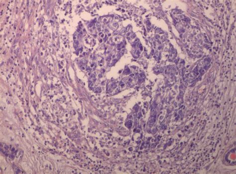 Infiltrative Ductal Carcinoma With Inflammatory Cells In The Stroma