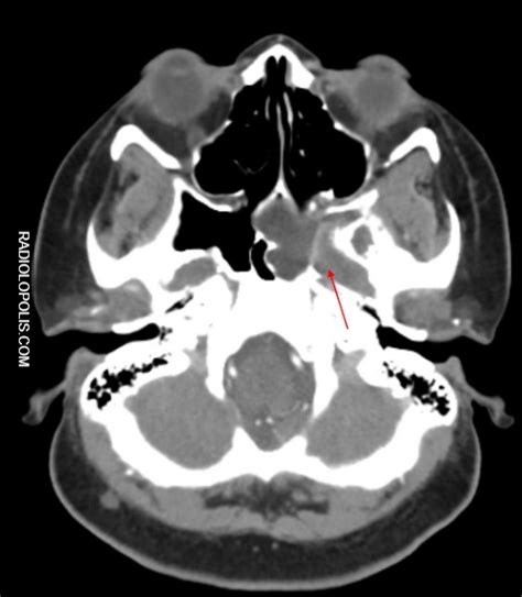 In axilla, this condition is known as axillary web syndrome. Radiolopolis