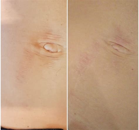 Stretch Marks Archives Lasermed Laser Clinic And Facial Rejuvenation