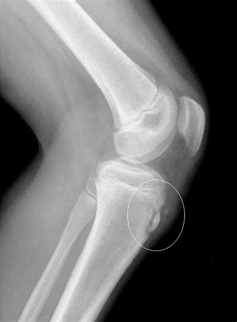 Figure 5 Tibial Tubercle Avulsion Fracture Pemxrays Flickr