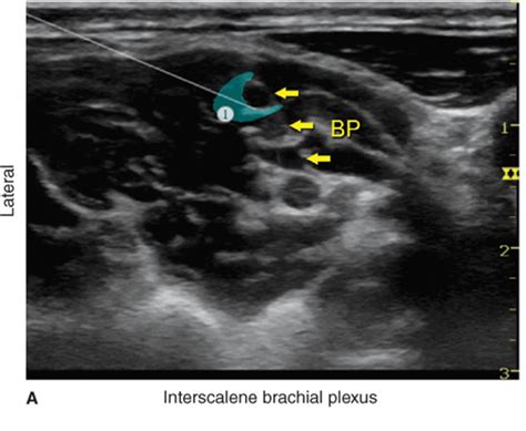 Ultrasound Guided Interscalene Brachial Plexus Block Hadzics Porn Sex