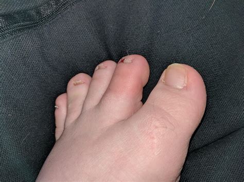 Is My Toe Infected Red Swollen And Extremely Itchy Keeps Me Awake At