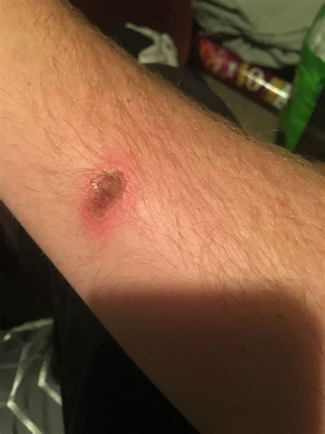 What Does A Brown Recluse Spider Bite Look Like At The Beginning