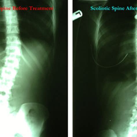 Bracing And Surgery Are No Longer Shailene Woodleys Only Options