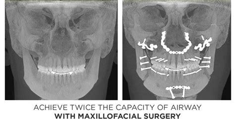 Orthognathic Surgery X Ray