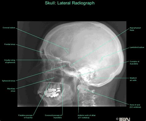 Skull X Ray Positioning Chart