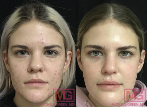 Ice Pick Acne Scars Dr Michele Green Md