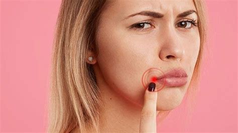 How To Get Rid Of Angular Cheilitis Best Treatment Options