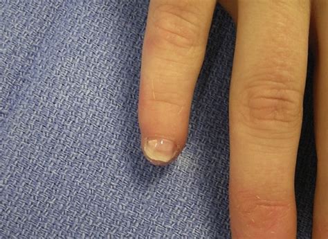 A Technique For Tripartite Reconstruction Of Fingertip Injuries Using