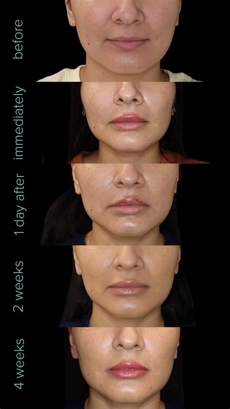 Stages Of Recovery Following Lip Filler Treatment