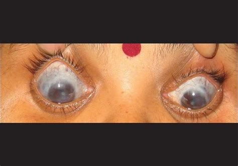 Management Of Bilateral Idiopathic Healed Sclerokeratouveitis With