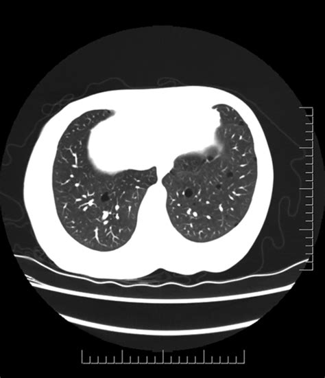 Ct Chest Imaging Scattered Thin Walled Cysts In Both Lung Fields Are