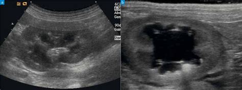 Can Ultrasound Detect Kidney Failure