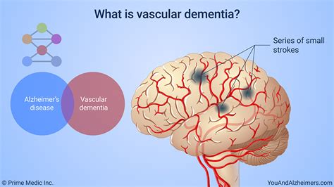 Slide Show Understanding Alzheimers Disease