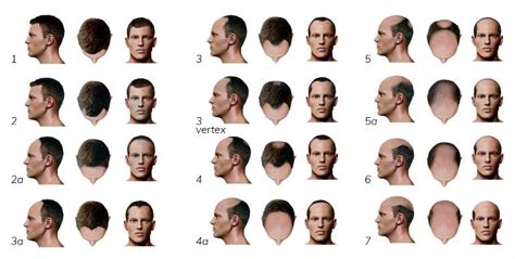 10 interesting facts about hair loss male or female pattern baldness raise your brain