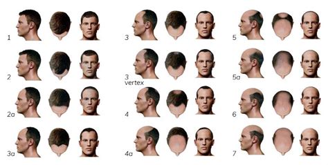 Or take care of things you can control, like staying in shape. 10 Interesting Facts about Hair Loss: Male or Female ...