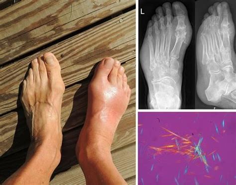 Gout Diagnosis Management And Therapy