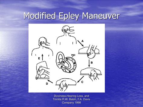 Get Epley Maneuver Steps With Pictures Pics