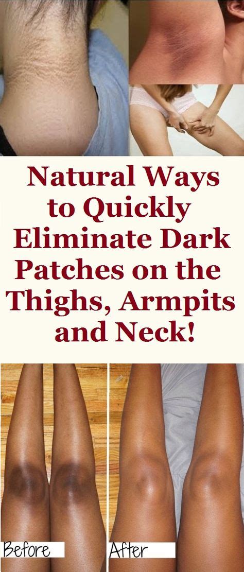 Natural Ways To Quickly Eliminate Dark Patches On The Thighs Armpits