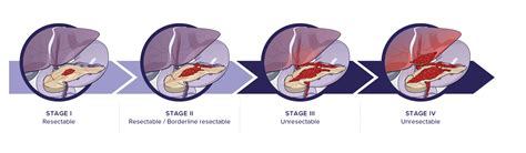 Stages Of Pancreatic Cancer