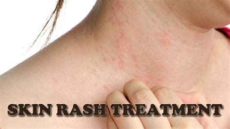 Dry Skin Rash Treatment