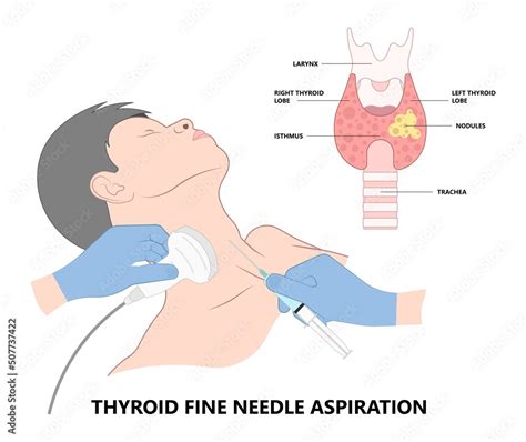 Thyroid Cancer Disease Nodules Ultrasound Screening Check Medical Treat