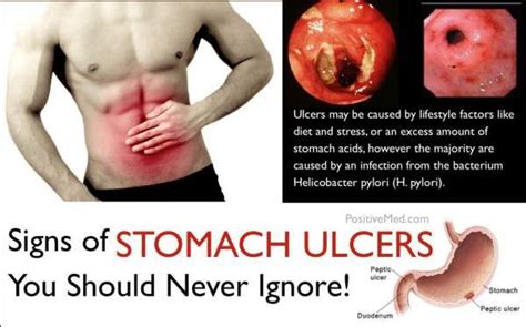 What Is Duodenal Ulcer Pain Like Girchar